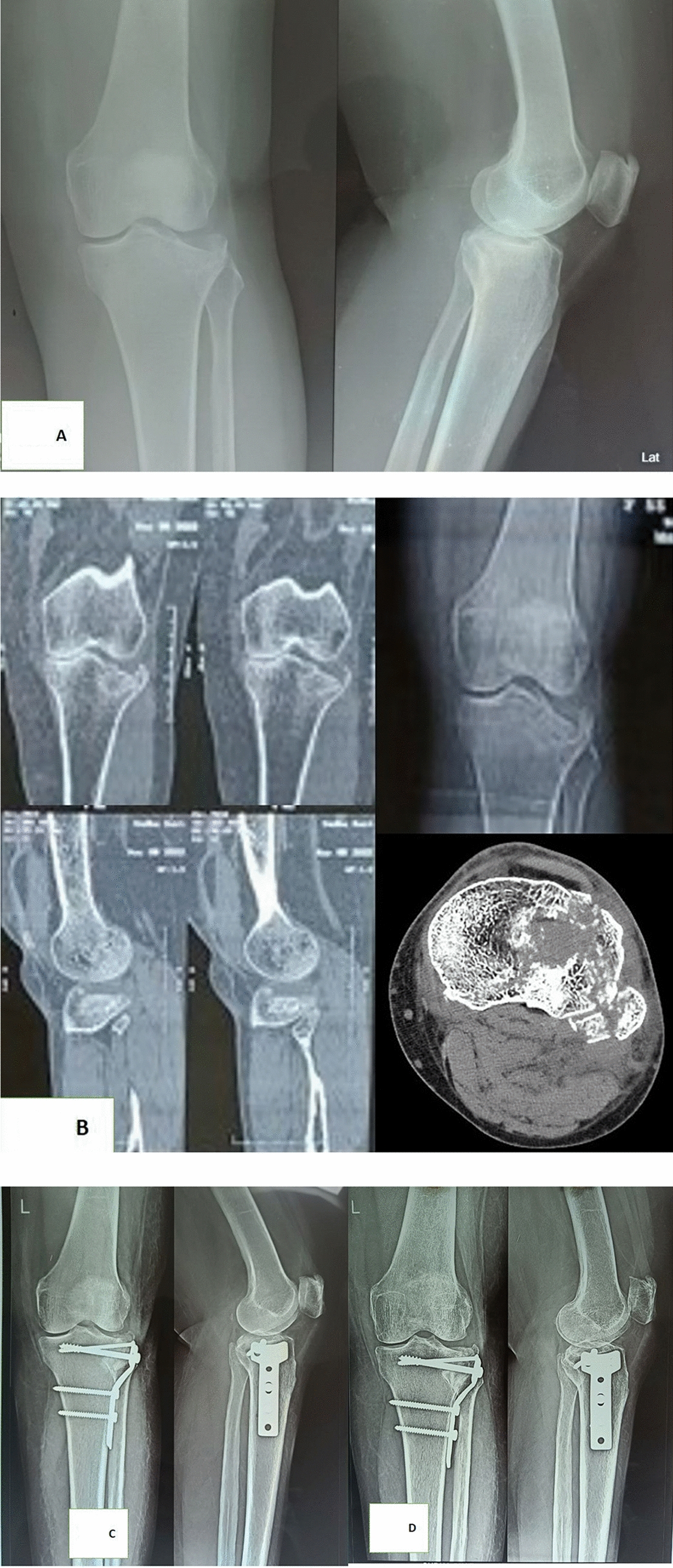 Osteosynthesis of Schatzker’s Type II and Type III Lateral Tibial Condyle Fracture With or Without Bone Graft—A Clinical and Radiological Prospective Study