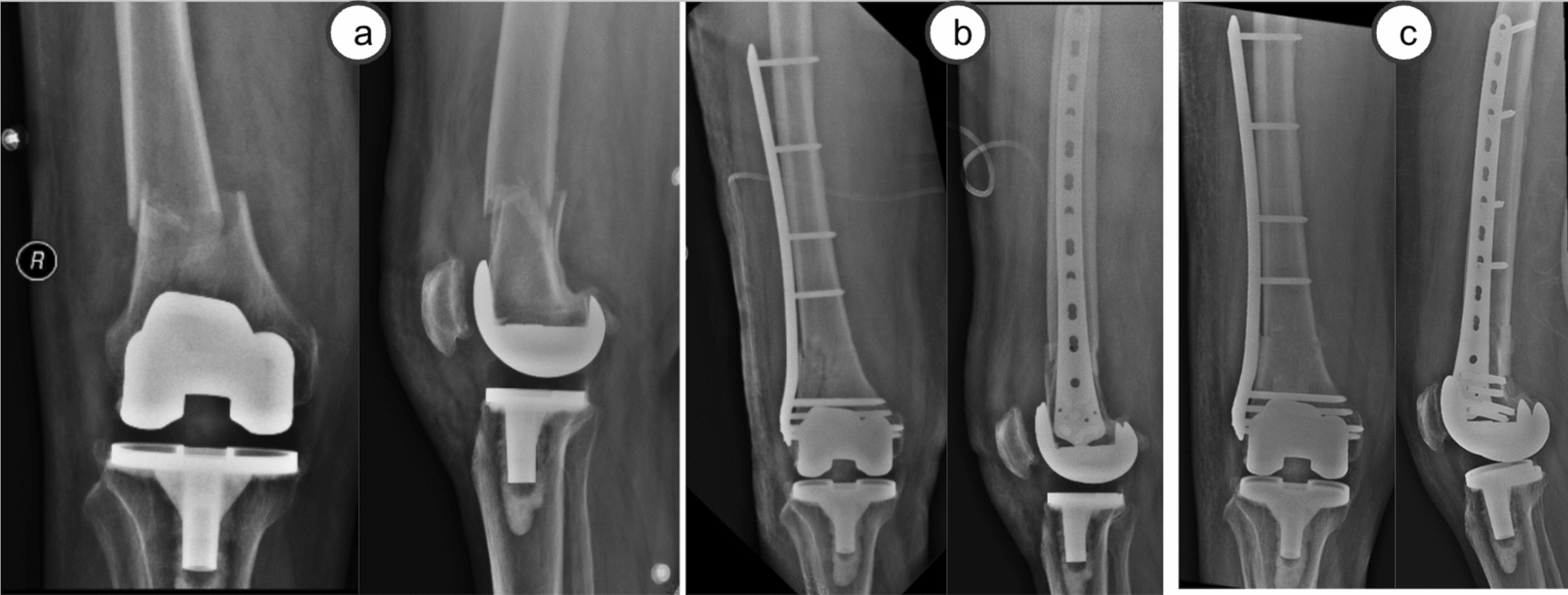 Periprosthetic Distal Femoral Fractures: Current Concepts and Management Strategies