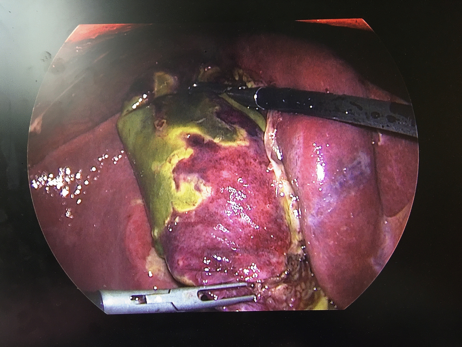 COVID-19 infection is a significant risk factor for death in patients presenting with acute cholecystitis: a secondary analysis of the ChoCO-W cohort study
