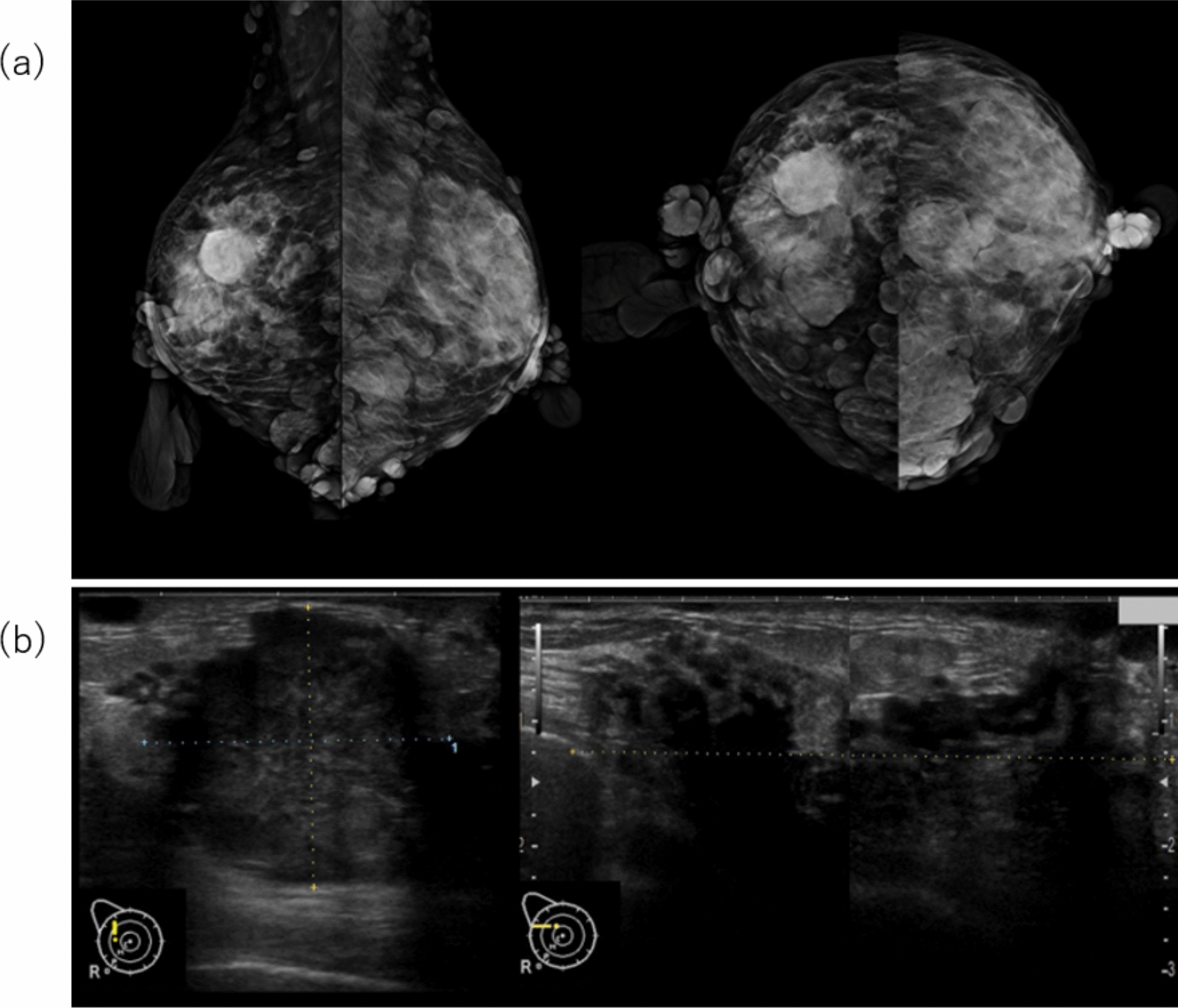 Co-occurrence of breast cancer and malignant peripheral nerve sheath tumor in a patient with neurofibromatosis type 1