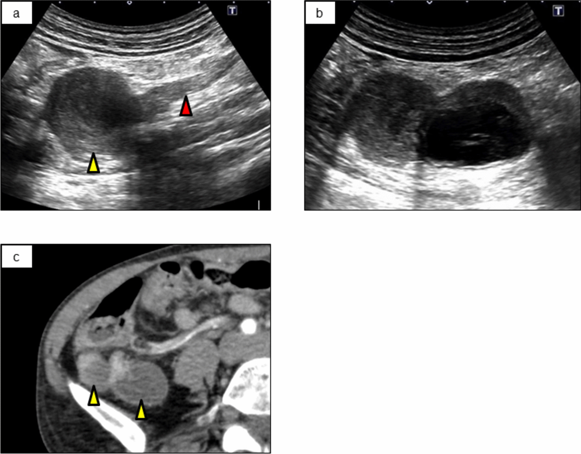 Laparoscopically resected appendiceal dual tumor composed of goblet cell carcinoma and low-grade mucinous neoplasm: a case report and literature review