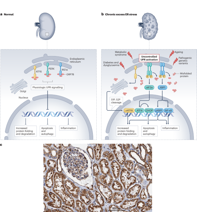 Endoplasmic reticulum stress as a driver and therapeutic target for kidney disease