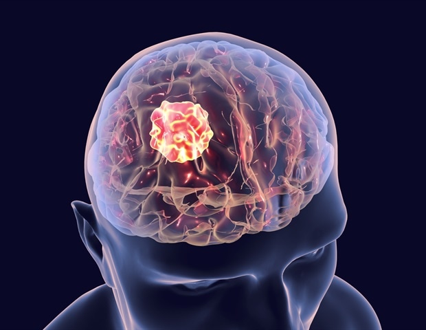 Already approved drug avapritinib shows promise in treating high-grade gliomas