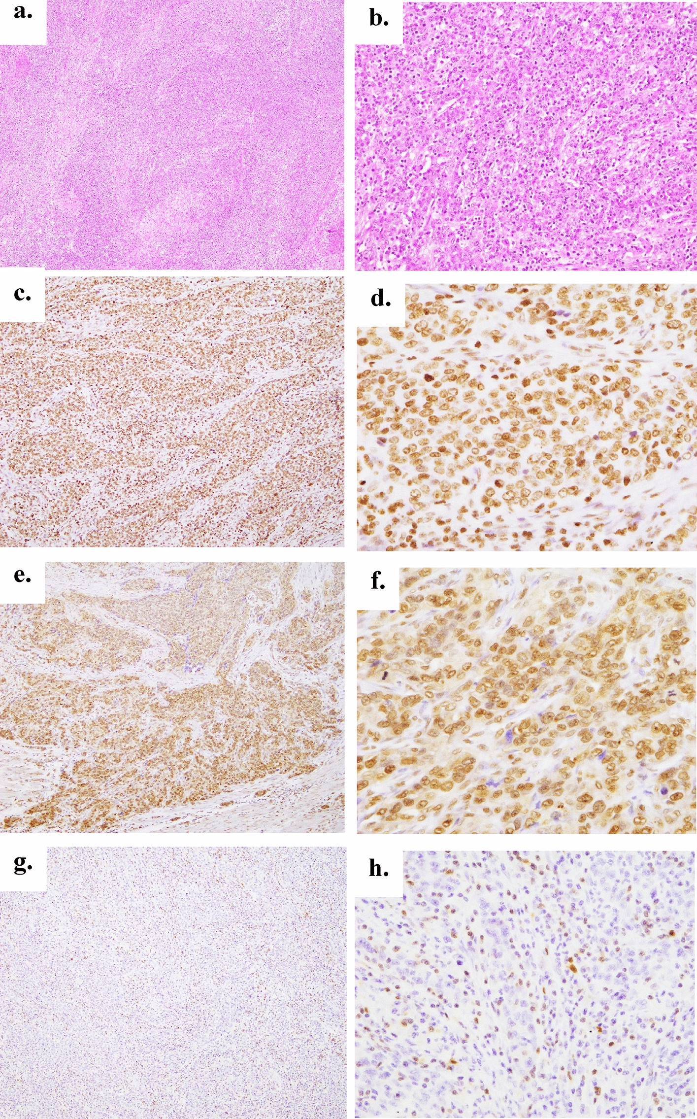 Clinicopathological significance of JAK2, STAT3, and STAT4 expression in patients with gastric solid-type poorly differentiated adenocarcinoma: a retrospective study