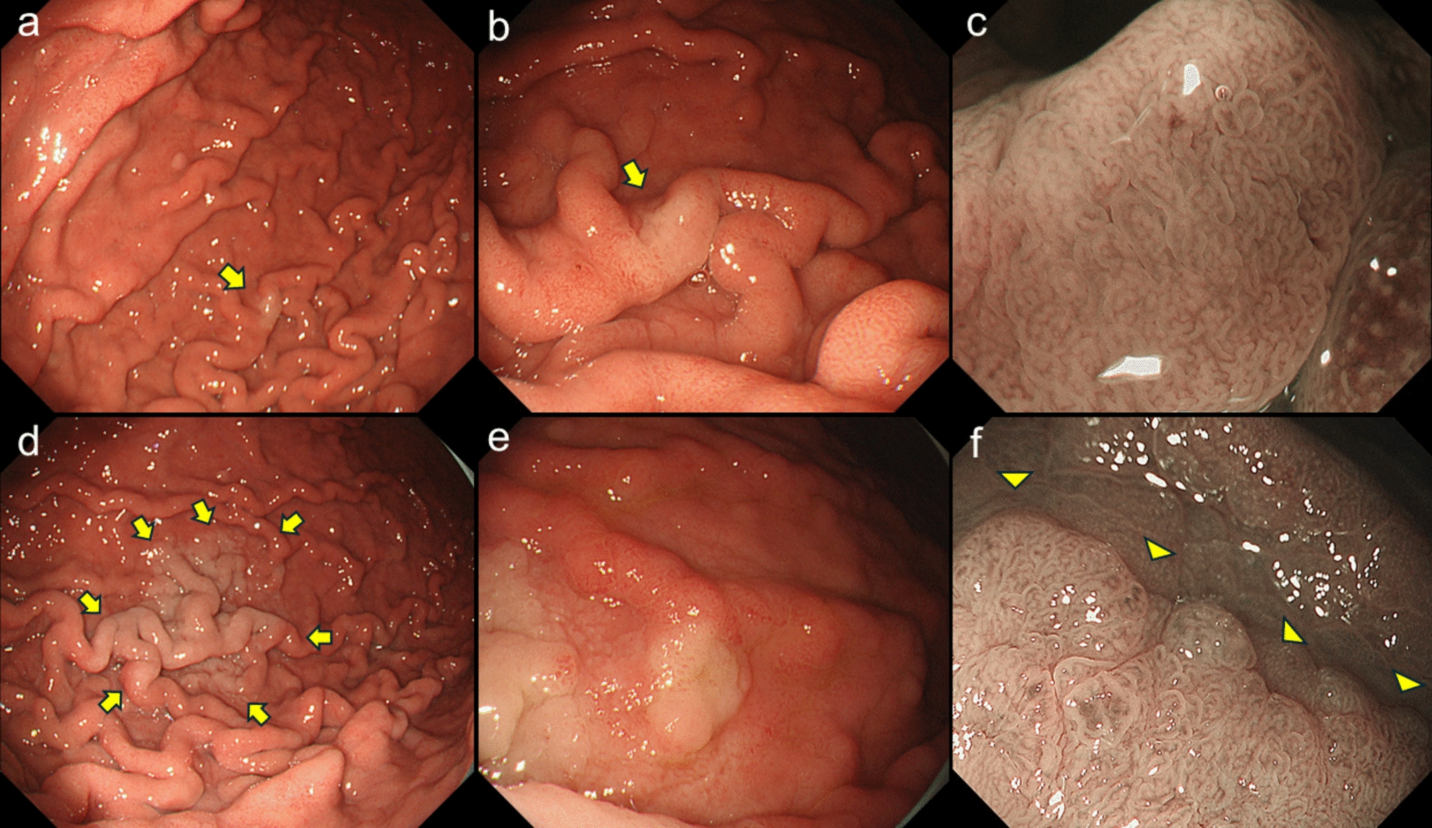 Multiple metachronous foveolar-type gastric adenomas in a -naïve patient with long-term use of a proton pump inhibitor: a case report