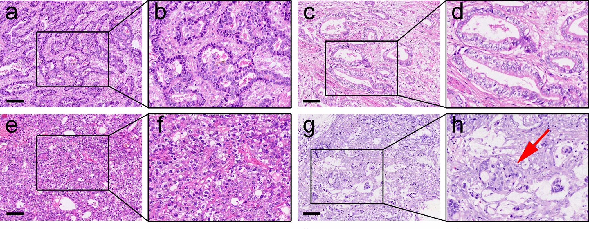 Genomic landscape and potential therapeutic targets in alpha-fetoprotein-producing gastric cancer