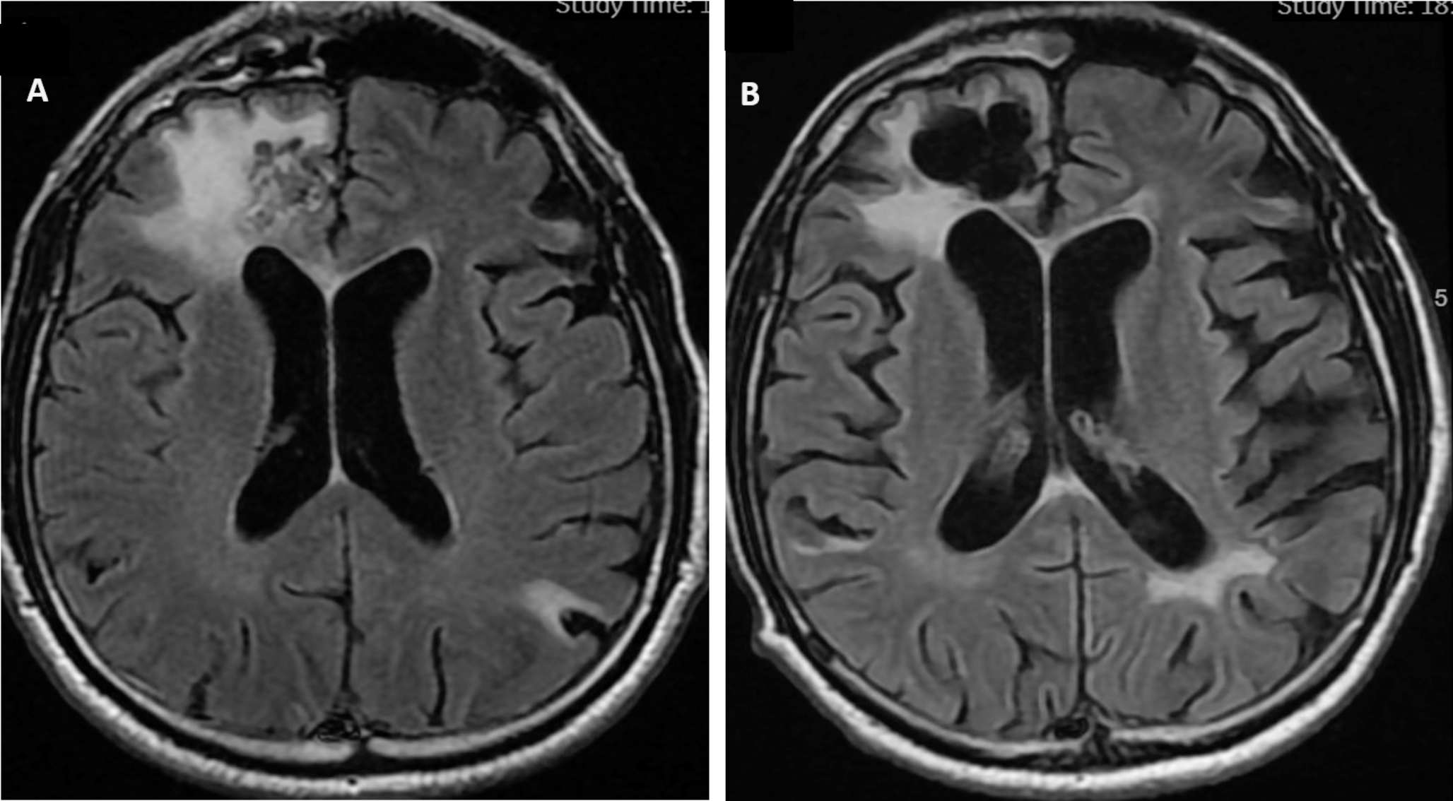 Chronic Neurological Complications of Brain Tumors and Brain Tumor Treatments
