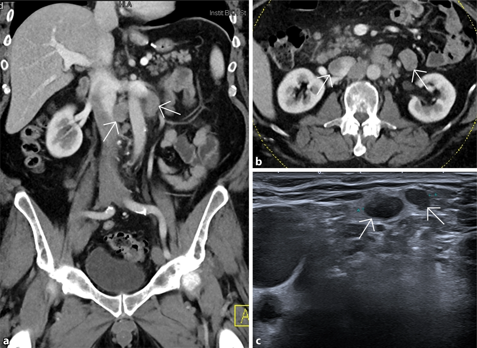 Rare case of human epidermal growth factor receptor 2-positive gastric remnant cancer after bariatric surgery—case report
