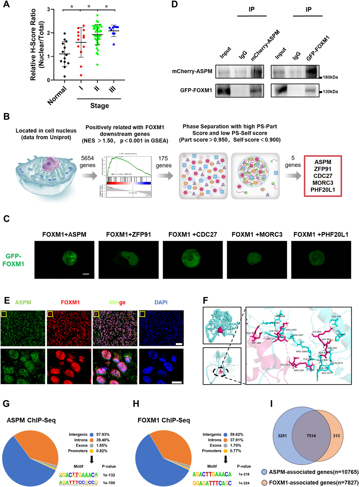 ASPM mediates nuclear entrapment of FOXM1 via liquid-liquid phase separation to promote progression of hepatocarcinoma