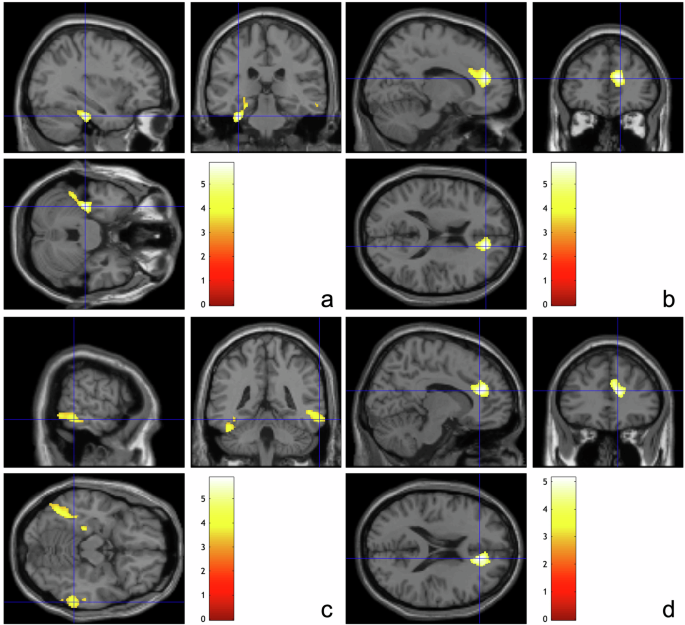 Grey matter morphometry in young adult e-cigarette users, tobacco cigarette users & non-using controls