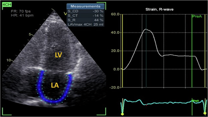 The hidden role of left atrial strain: insights into end-organ damage in dipper and nondipper hypertension