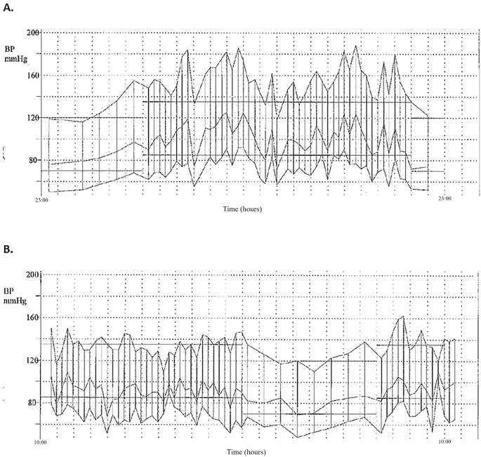 Ambulatory blood pressure monitoring before and after resection of catecholamine-secreting pheochromocytoma or paraganglioma