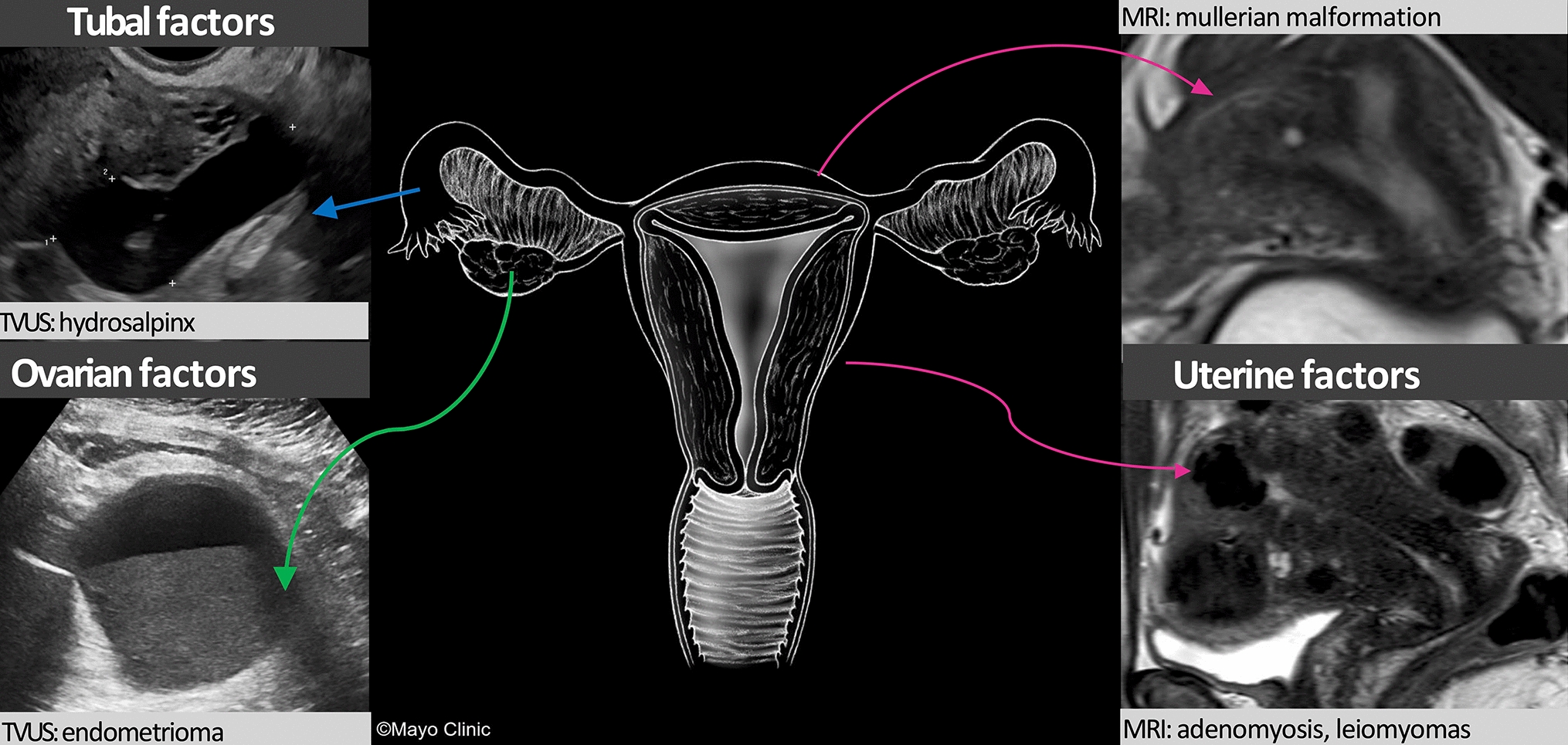 Endometriosis: a journey from infertility to fertility