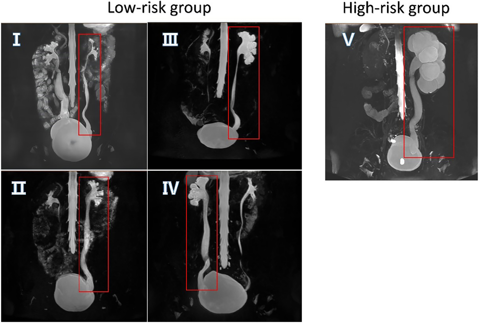 Non-contrast cine magnetic resonance urography in evaluating and monitoring of primary obstructive megaureter: a case series study
