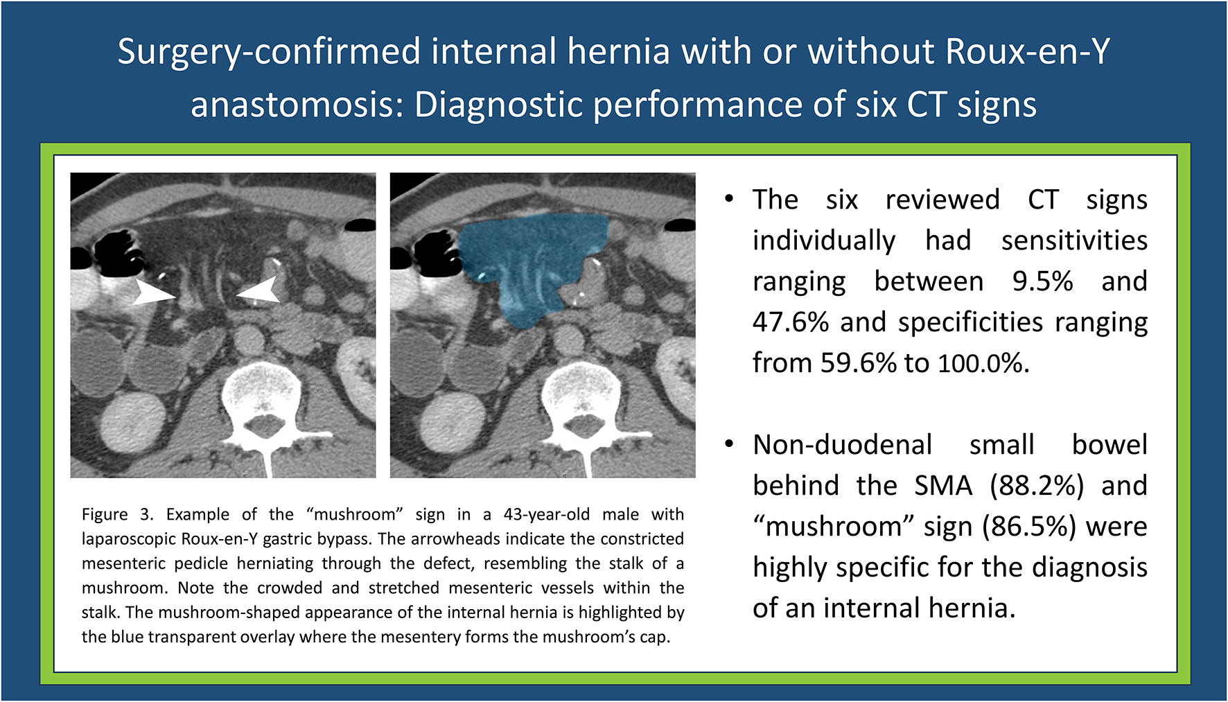 Surgery-confirmed internal hernia with or without Roux-en-Y anastomosis: diagnostic performance of six CT signs