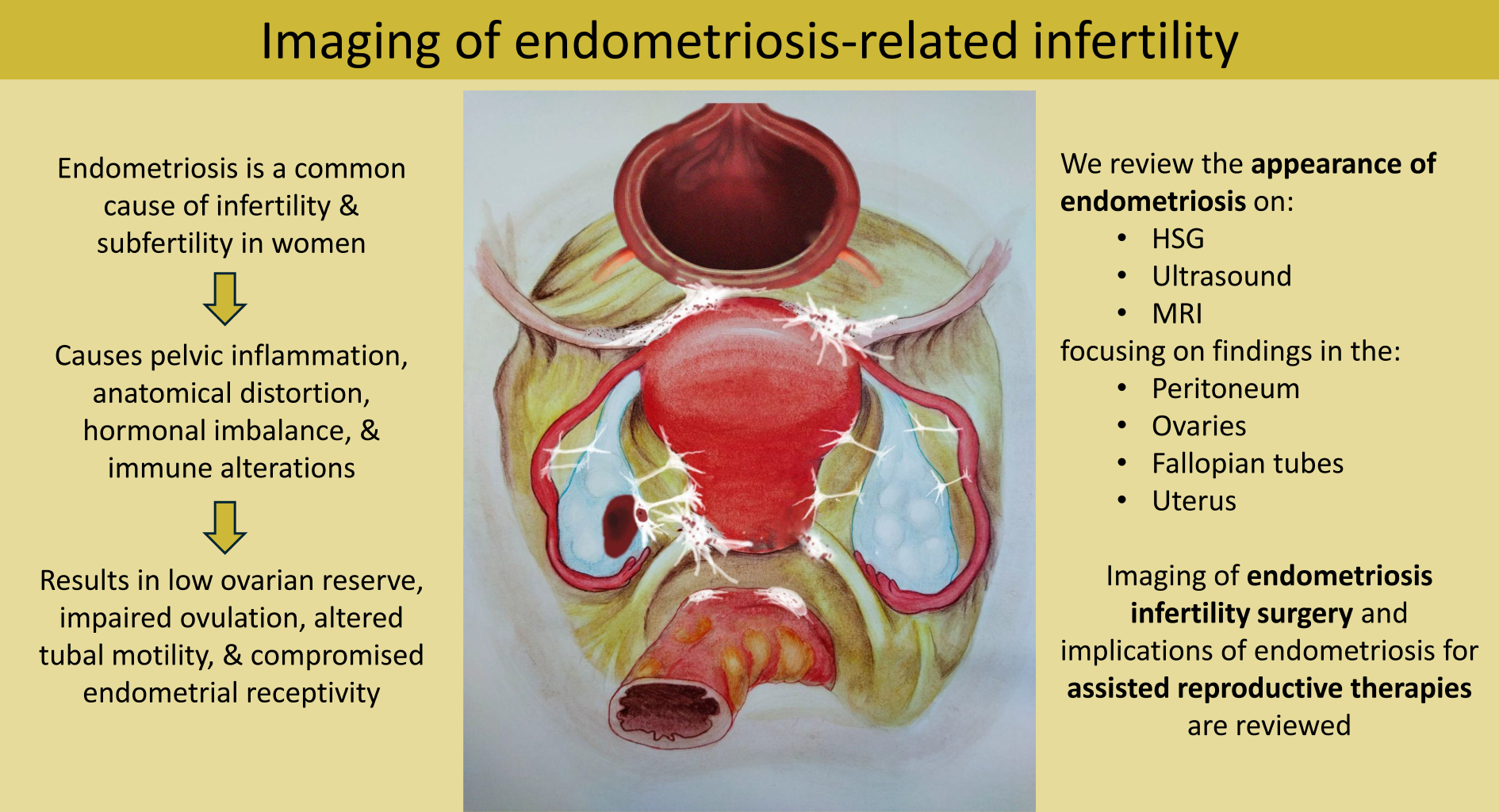 Imaging of endometriosis-related infertility