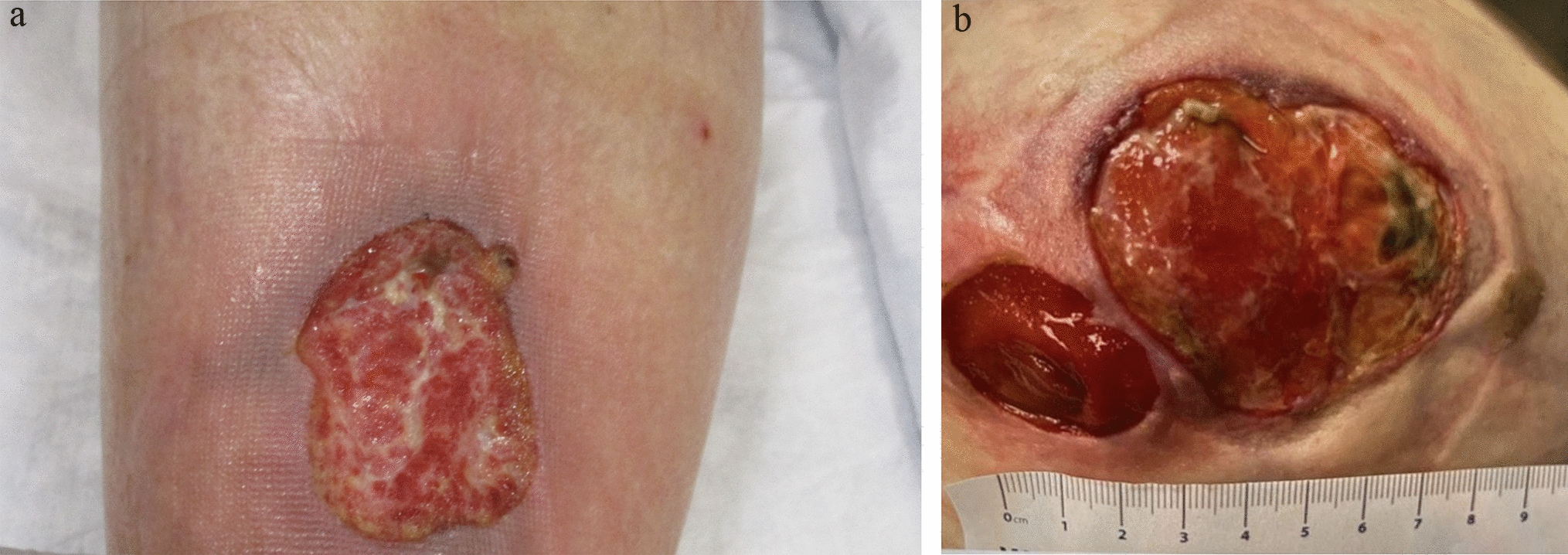 Clinical Mimickers Misdiagnosed as Pyoderma Gangrenosum