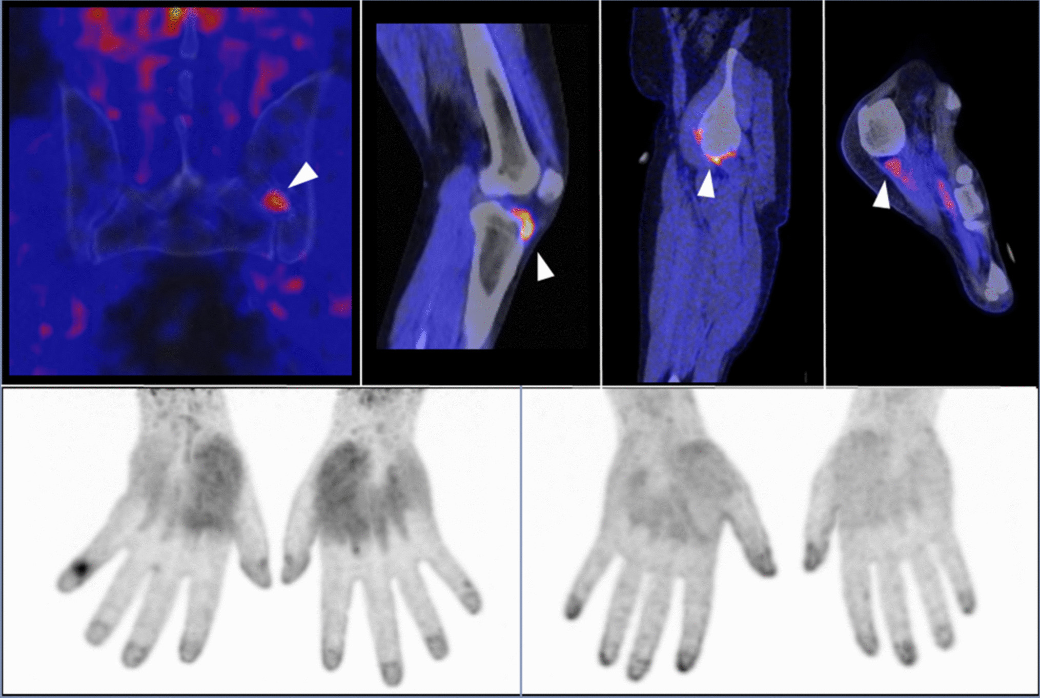 Unconventional Imaging Methods in Psoriatic Arthritis