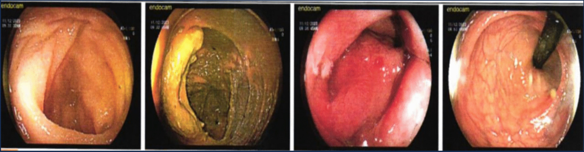 A Case Study on Complete Pathological Response in Advanced Rectal Cancer Patient with Oxaliplatin-based Chemotherapy without Cumulative Neurotoxicity