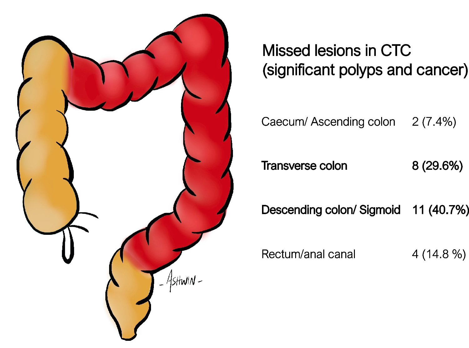 Diagnostic Yield of Combining CT Colonoscopy and Endoscopy to Investigate Colorectal Cancer