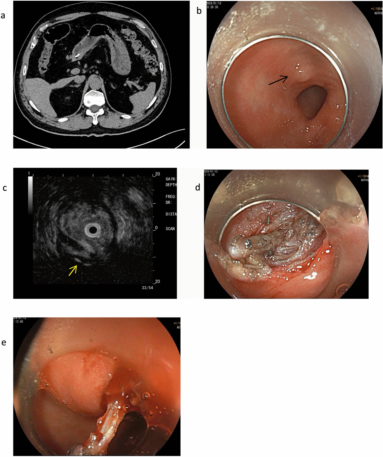 Endoscopic Ultrasound-Assisted Endoscopic Submucosal Dissection for the Removal of a Toothpick