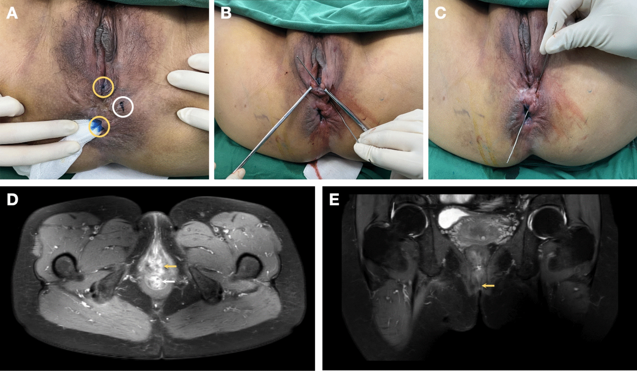 Transanal Opening of the Intersphincteric Space (TROPIS): Combined with Suture-Dragging for Treating of Rectovaginal and Perianal Fistulas in Crohn’s Disease with Anorectal Stricture