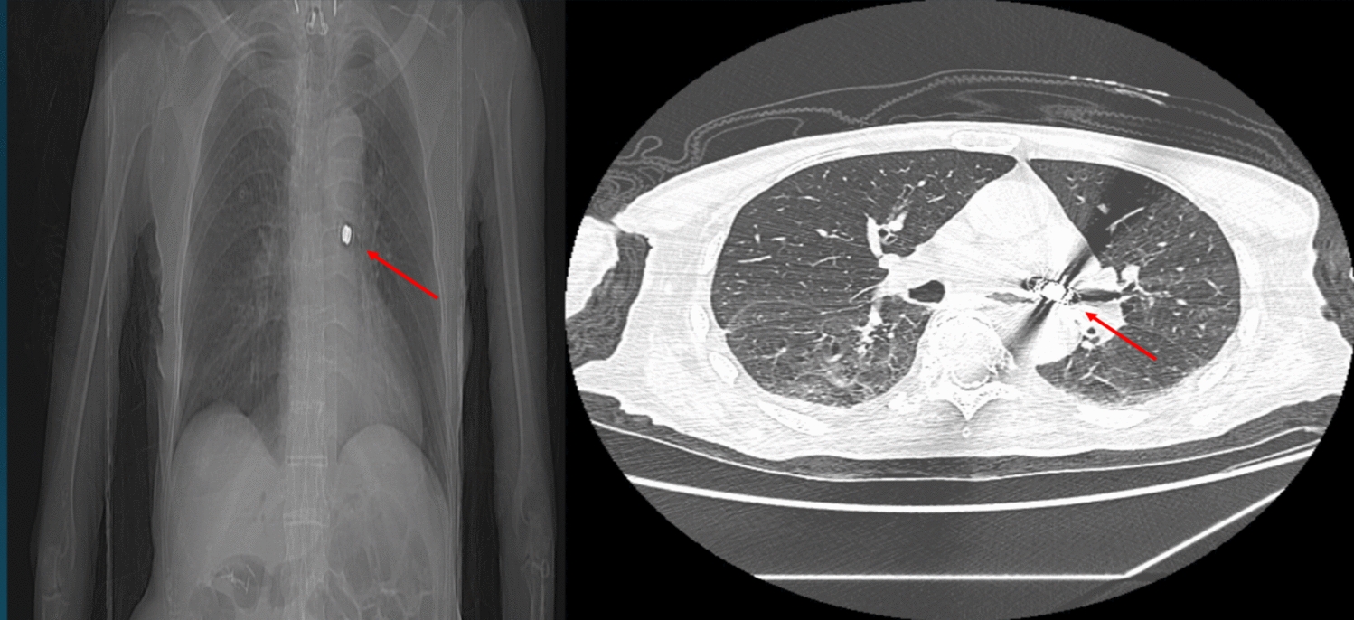 Endoscopic Capsule Removal from the Left Main Bronchus with a Gastroscope