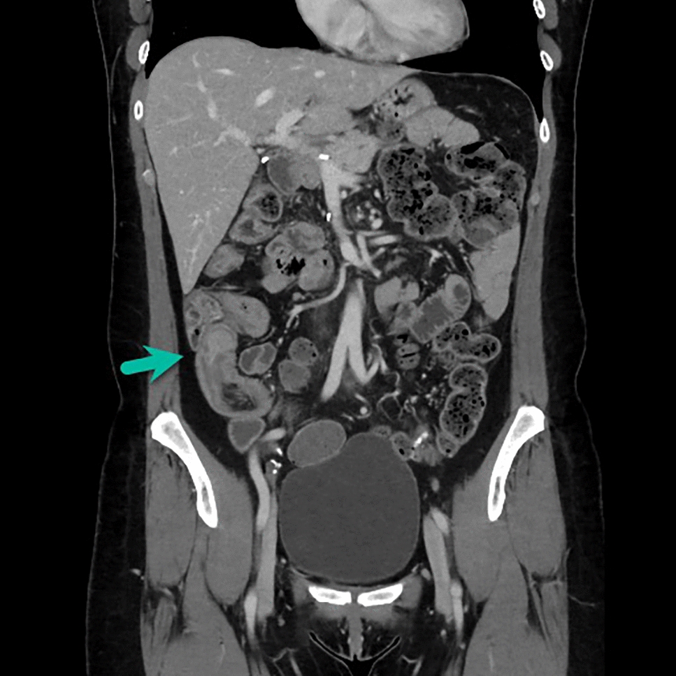 Vanished! Auto-amputated Ileal Polyp in a Patient with Lynch Syndrome