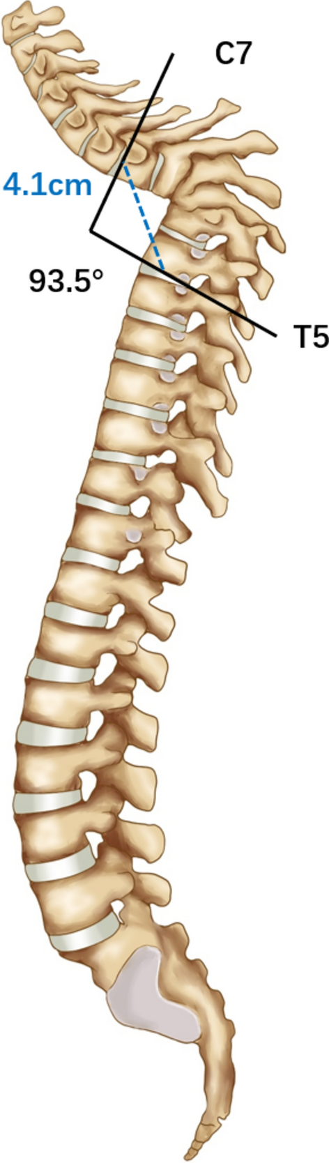 A new predictive factor for postoperative neurological deficits in patients with severe post-tuberculous kyphosis: the deformity angular distance ratio