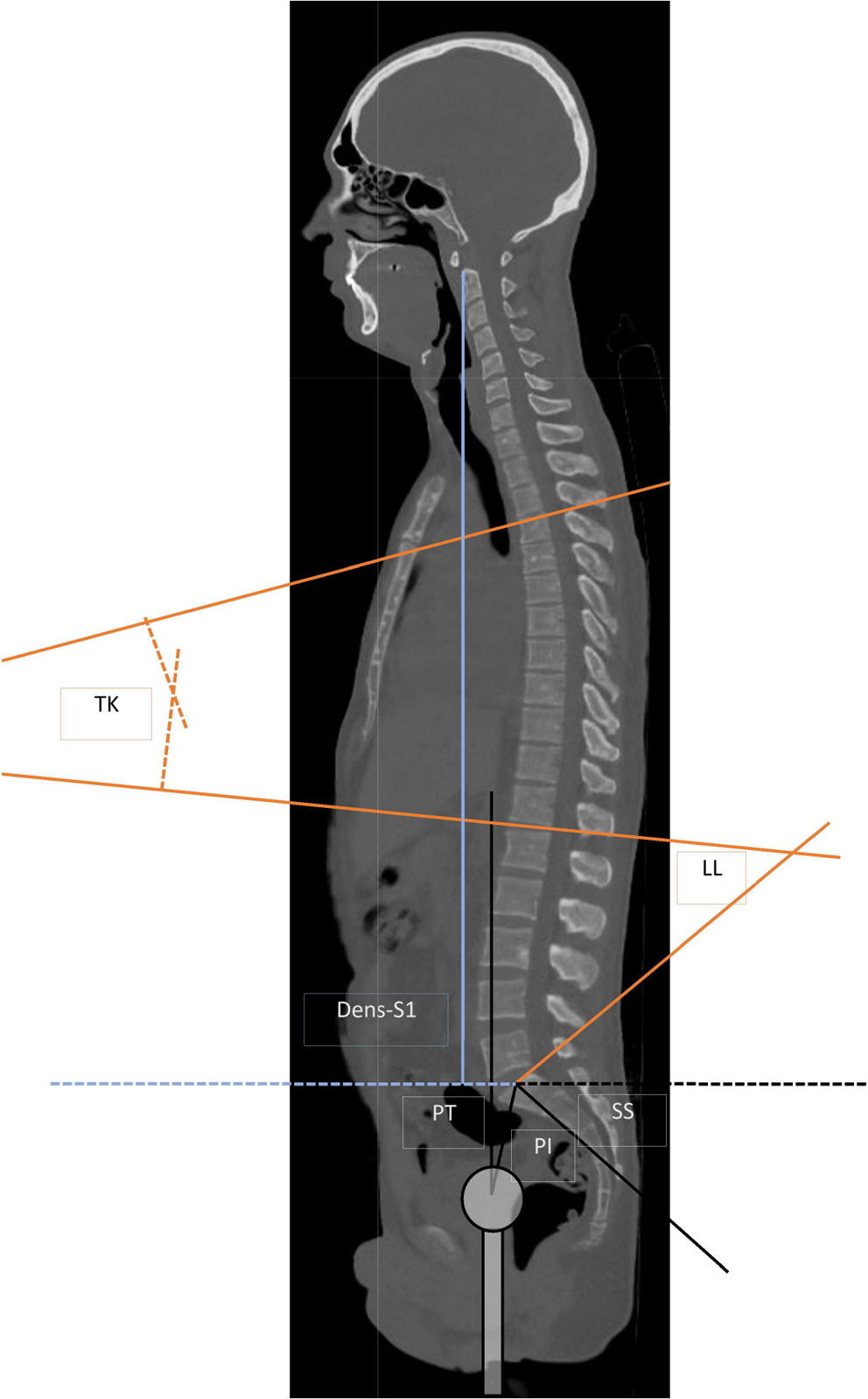 Changes in sagittal spinopelvic alignment are associated with increased pain and impaired function in multiple myeloma patients