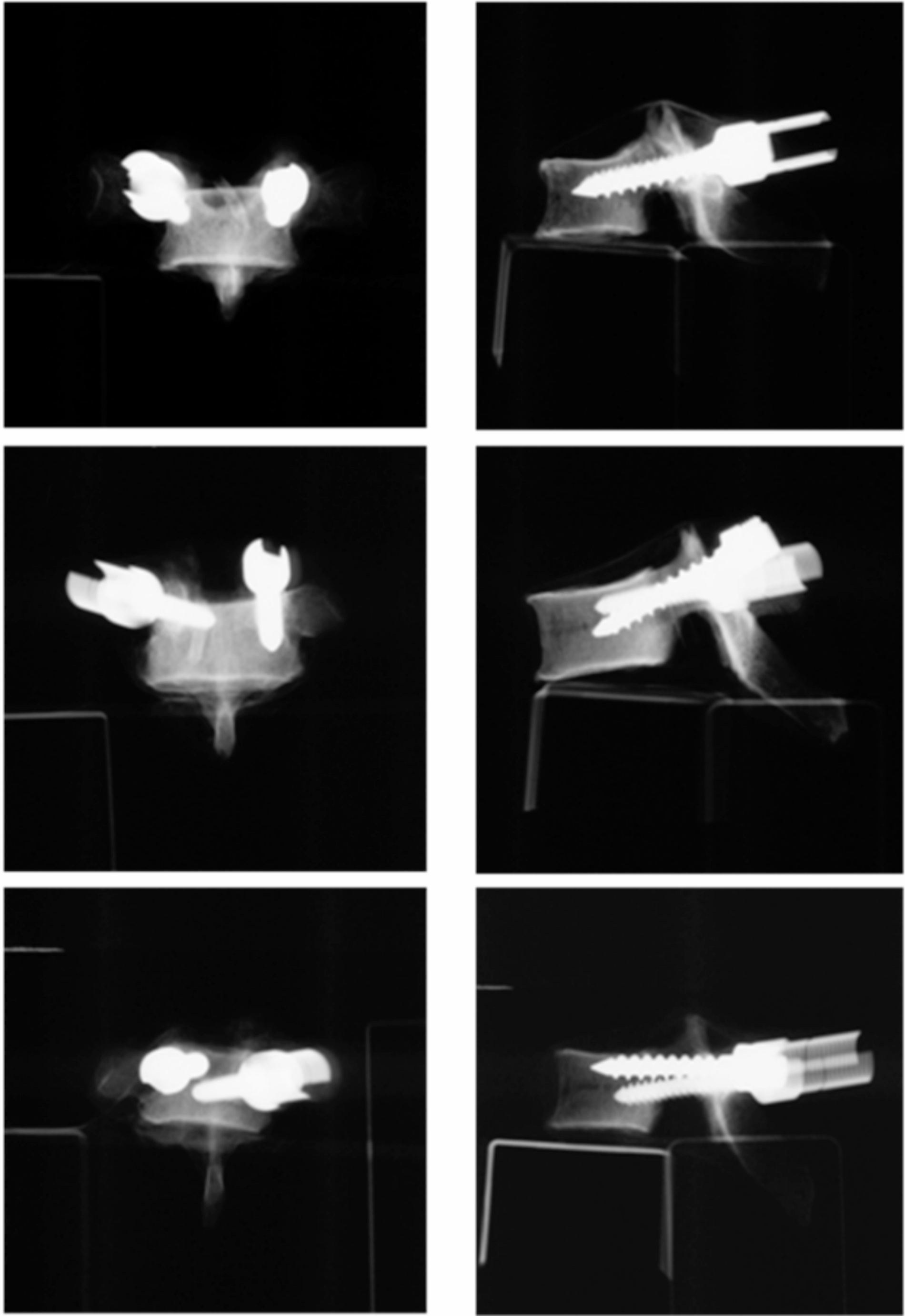 The use of orthogonal plain radiographs in determining the position of thoracic pedicle screws: a cadaveric study