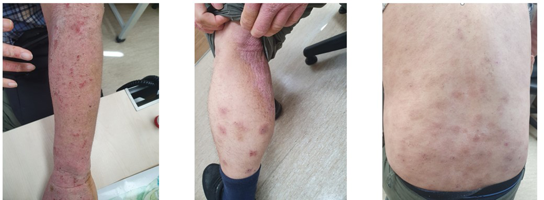 Successful dupilumab treatment in a patient with severe dermatitis following allogenic hematopoietic stem cell transplantation