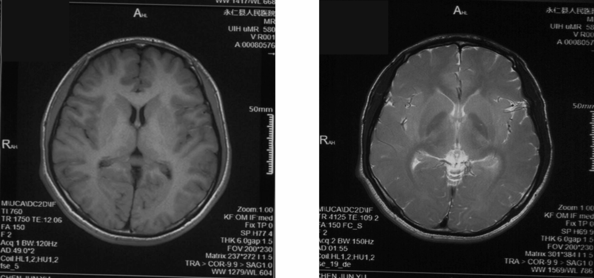 A case of fatal chlorfenapyr poisoning: evidence from histopathology and autopsy