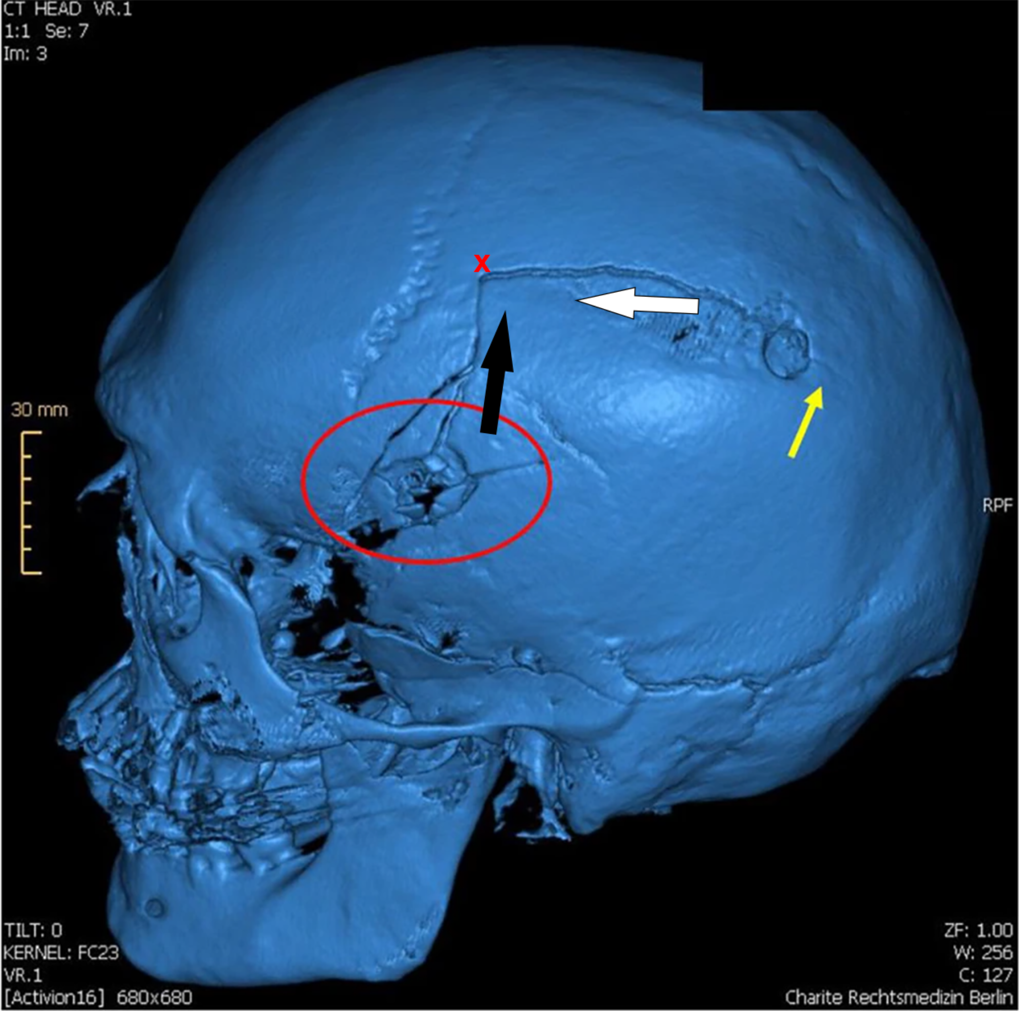Regarding the possible “exception” to Puppe’s rule in gunshot wounds to the skull with a burr hole