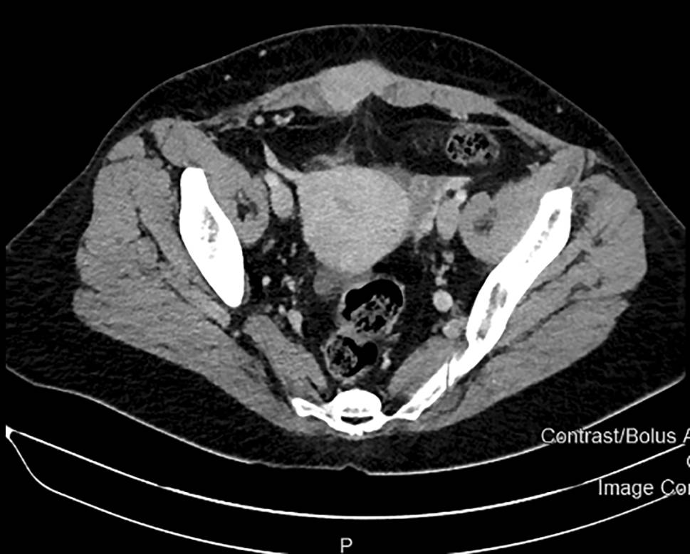 Uncommon presentation of an abdominal wall tumor