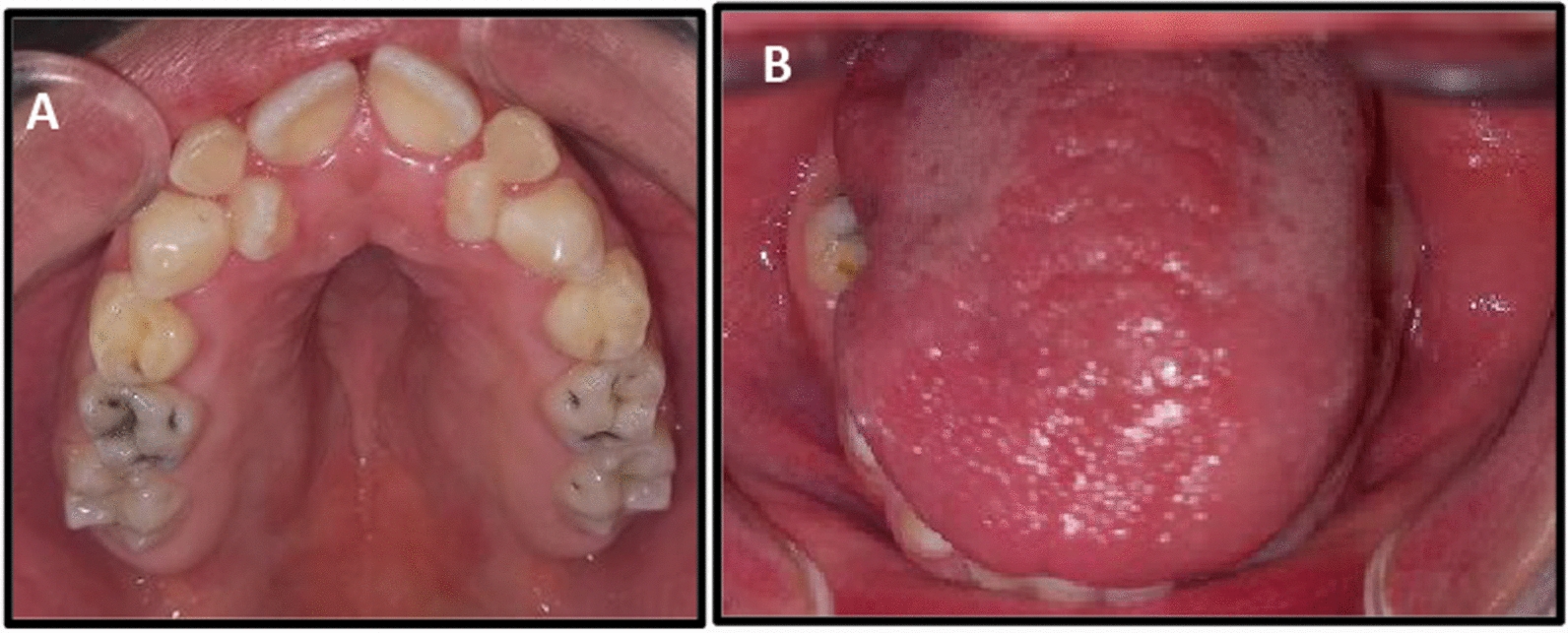 Prevalence and characteristics of oral and dental anomalies in Tunisian individuals with Down syndrome: a descriptive study
