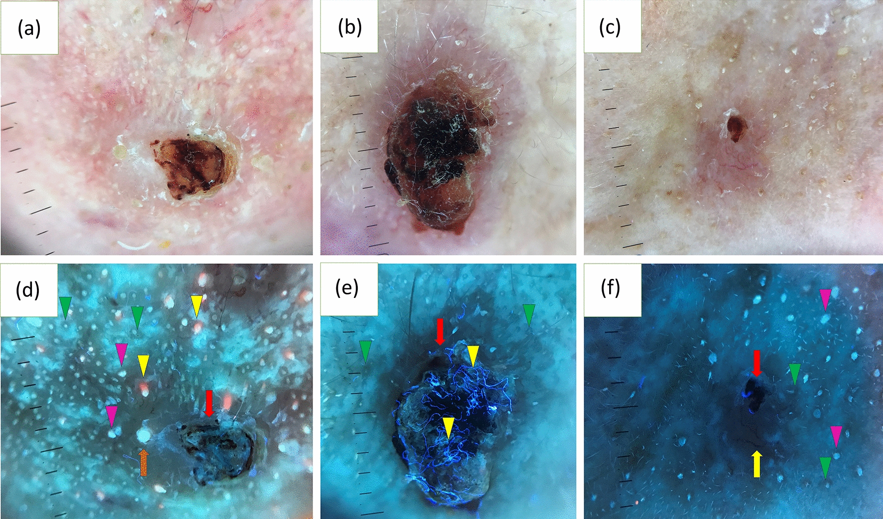 Polarized Dermoscopy and Ultraviolet-Induced Fluorescence Dermoscopy of Basal Cell Carcinomas in the H- and Non-H-Zones of the Head and Neck