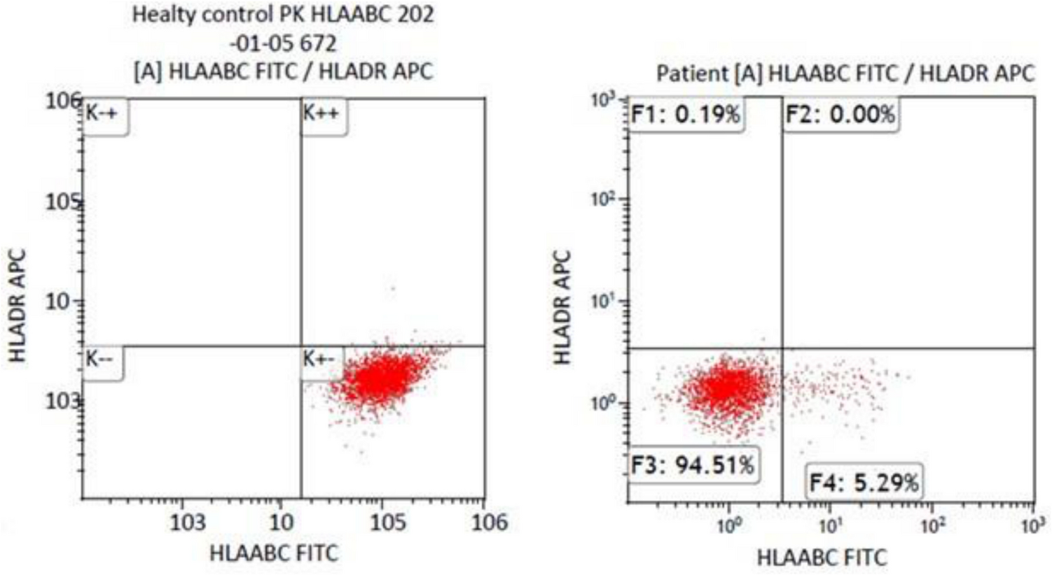 A patient with  variant causing an expression defect in both HLA ABC and HLA DR