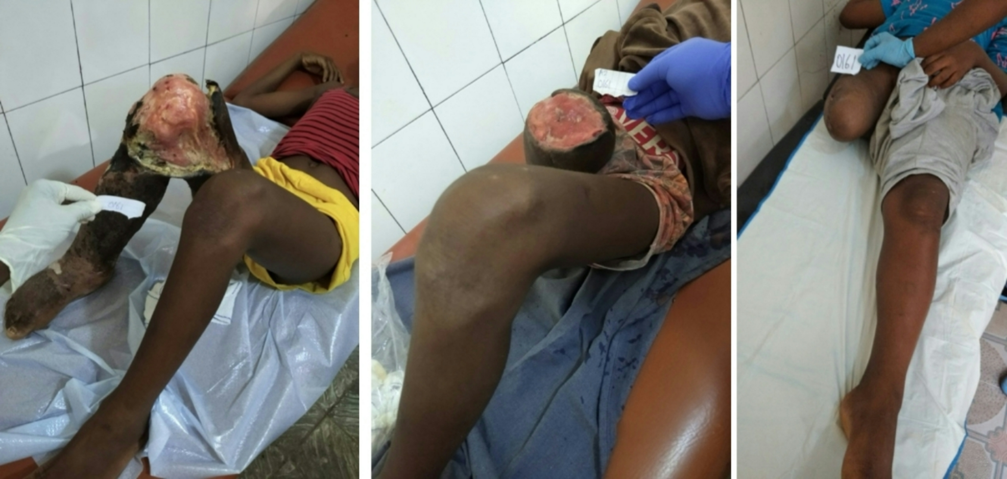 Suspected Buruli ulcer cases in Tonkolili District, Sierra Leone– a prospective cohort study
