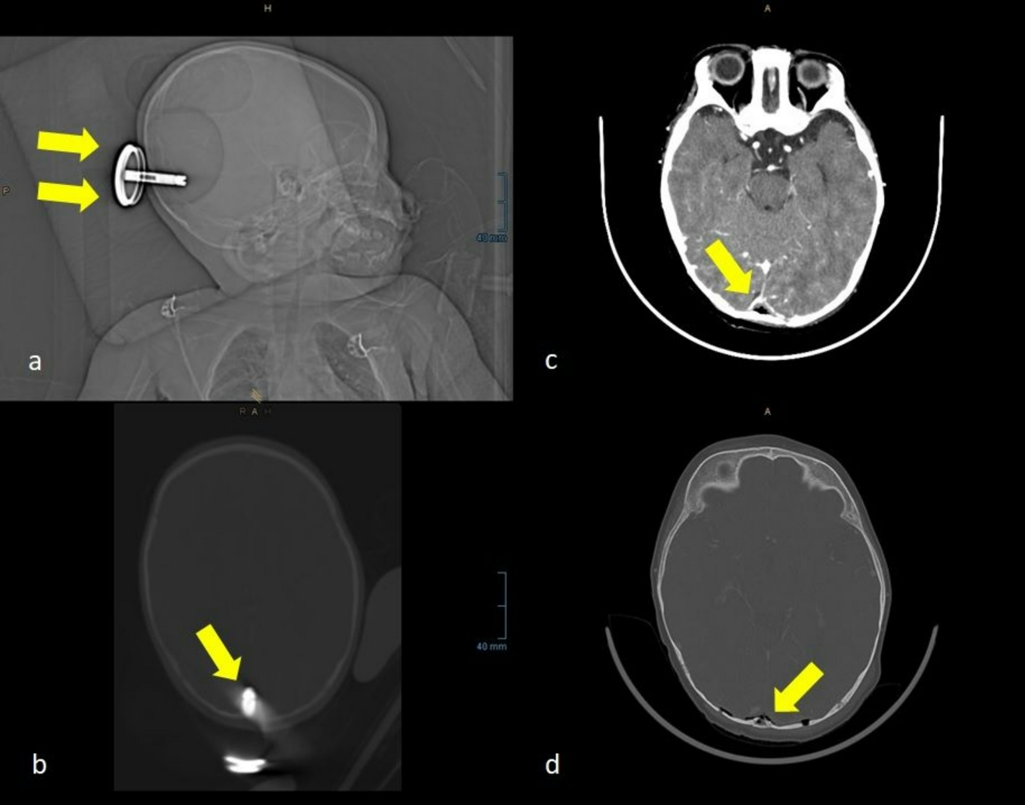 infection: a rare case of  resistance to amphotericin b following traumatic intracranial injury in an 18-month-old boy