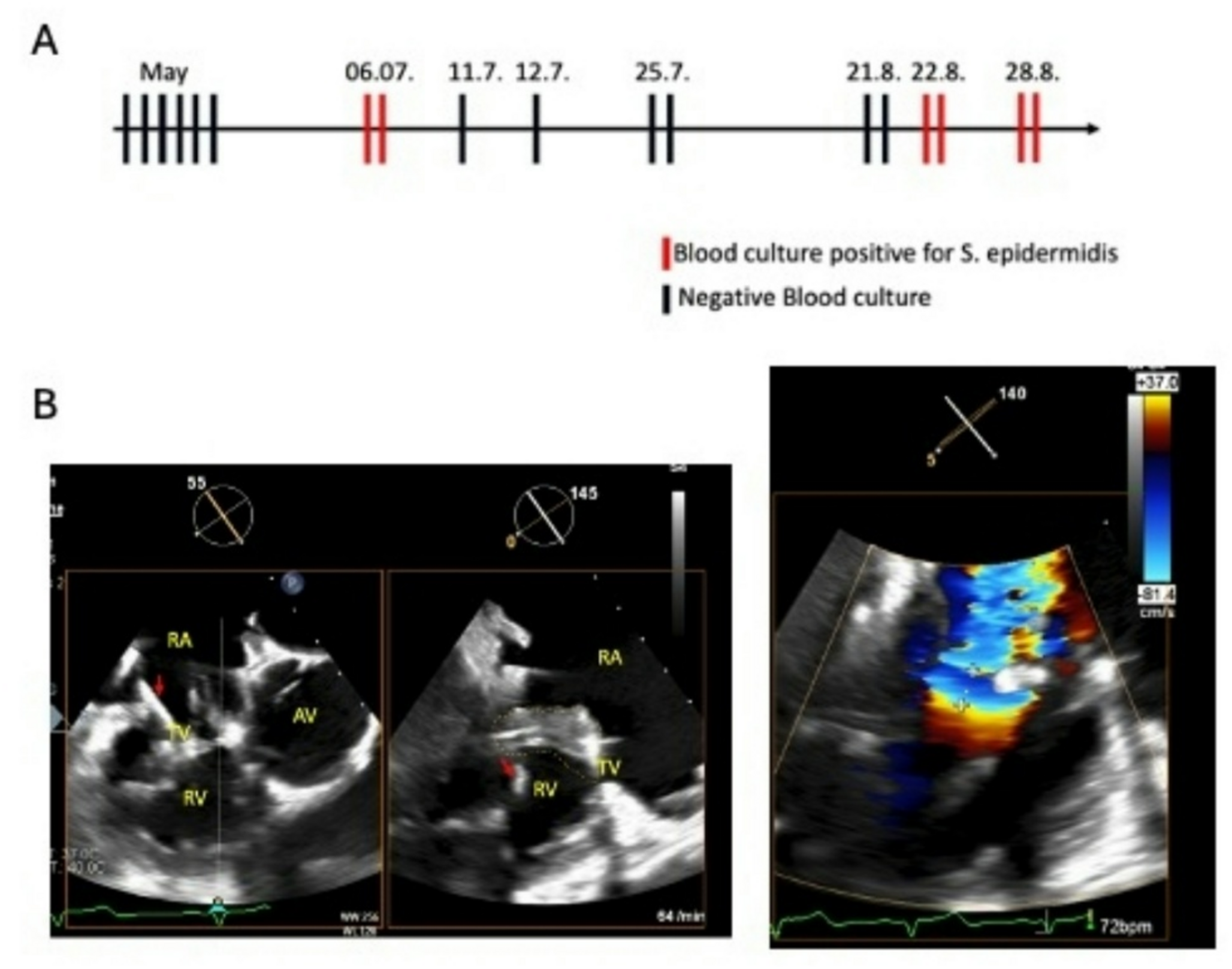 Cellulosimicrobium cellulans endocarditis: a challenge for detection and treatment in interdisciplinary teams