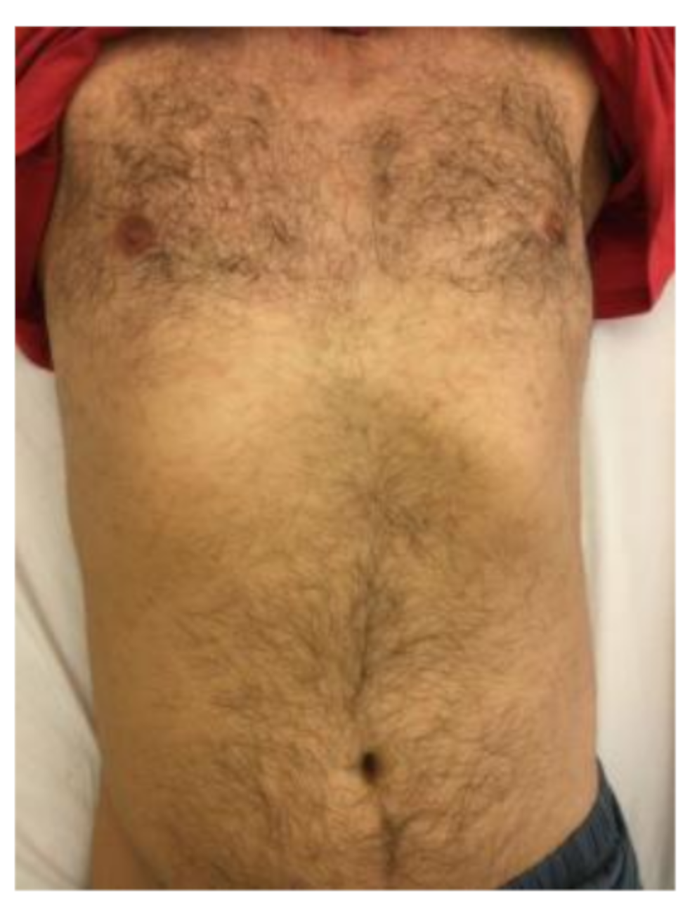 A very rare case of osseous involvement of the dens axis in a 52-year-old HIV positive patient as part of secondary syphilis