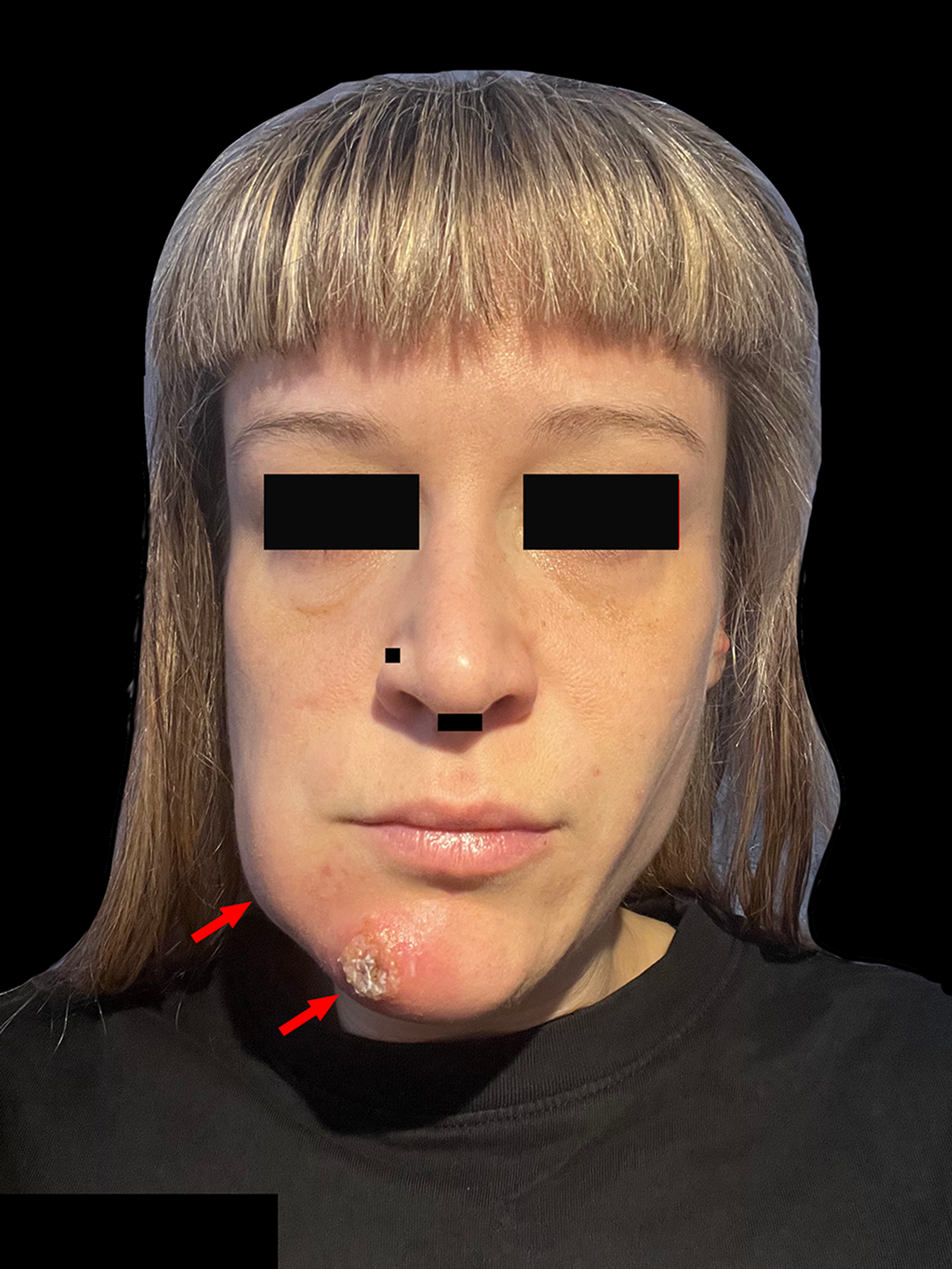Unusual case of non-sexual Mpox transmission in a heterosexual woman