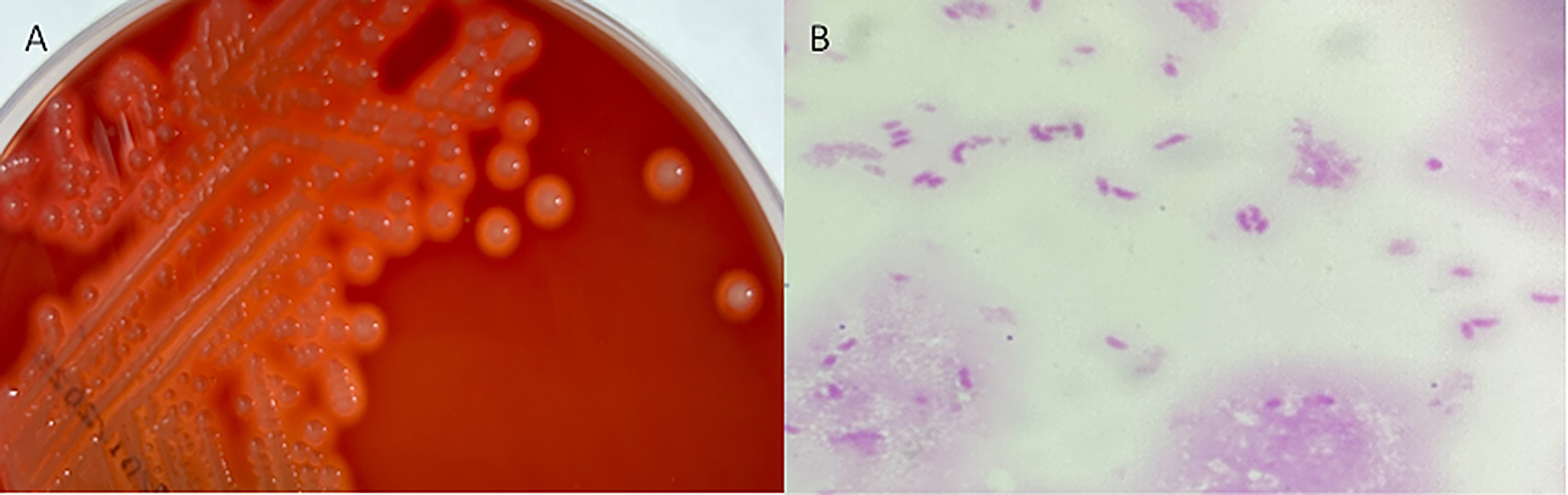 Vibrio fluvialis cholangitis with bacteremia and refractory septic shock: a case report and review of the literature