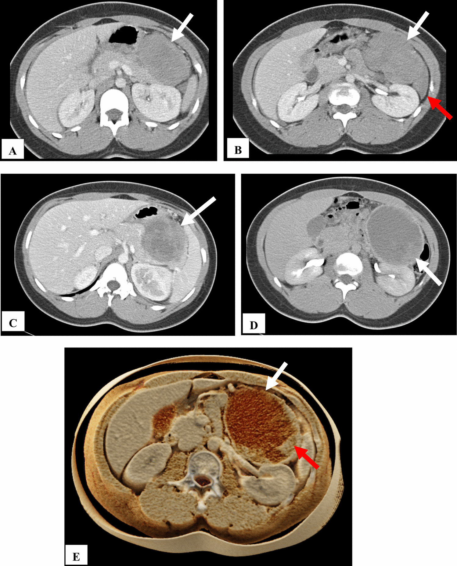 Spontaneous rupture of solid pseudopapillary neoplasm (SPN) of the Pancreas – imaging insights and review of the literature