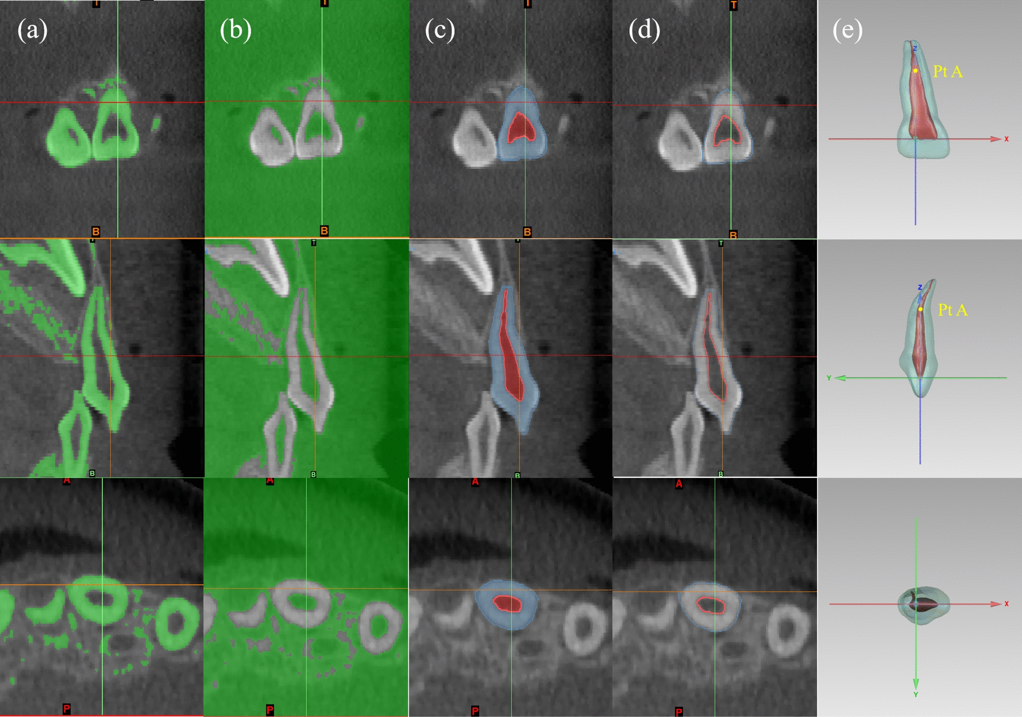 Three-dimensional morphological evaluation of anatomical models for 101 primary maxillary central incisors