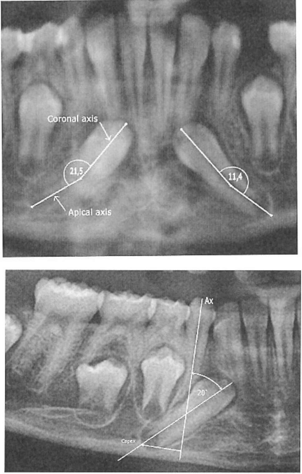 Eruptive movements of ectopic permanent mandibular canines: a case series study based on serial orthopantomograms from ten children with unilateral ectopia and six children with bilateral ectopia