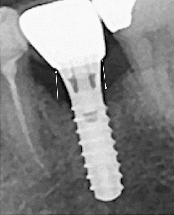 Marginal Bone Loss Around Dental Implants and Its Association with Chronic Corticosteroid Use: A Prospective Cohort Study