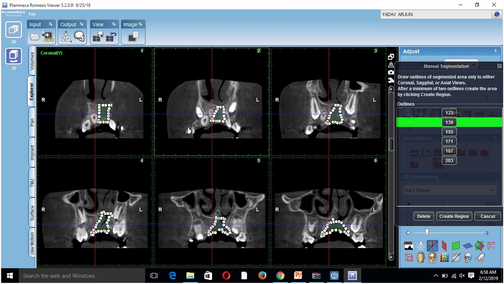Photogrammetric Outcomes of the Effects of Cancellous Versus Cortico-Cancellous bone Graft on Alar Base Symmetry Among Unilateral Cleft Alveolus Patients: A Randomized Controlled Trial