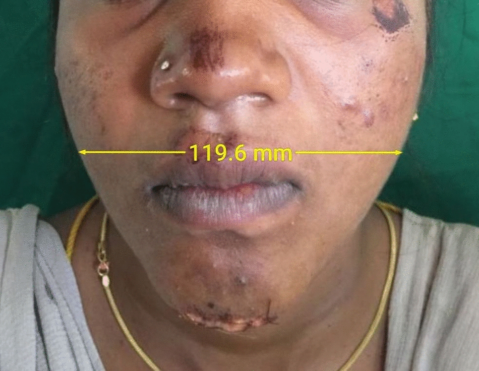 The Restoration of Lower Facial Width in Trifocal Mandibular Fractures Using Pre-fabricated Inter-Occlusal Splint: A Clinical Study